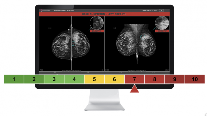 Therapixel receives CE mark for AI-based software MammoScreen